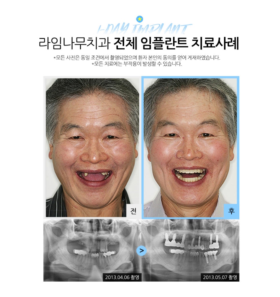 임플란트, 단돈 40만원으로 할 수 있다고요? 관련 이미지 5