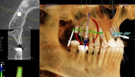 [명동치과]라임나무치과의 전체 임플란트를 소개합니다 관련 이미지 3