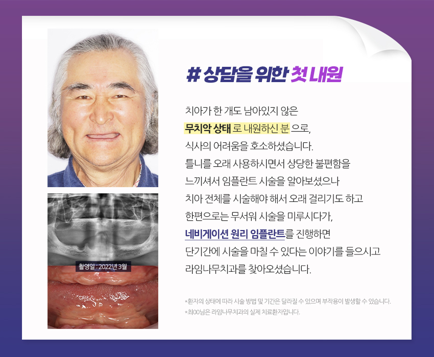 [라임나무치과]네비게이션 원리 임플란트, 실제 사례를 통해 알아봤습니다. 관련 이미지 2