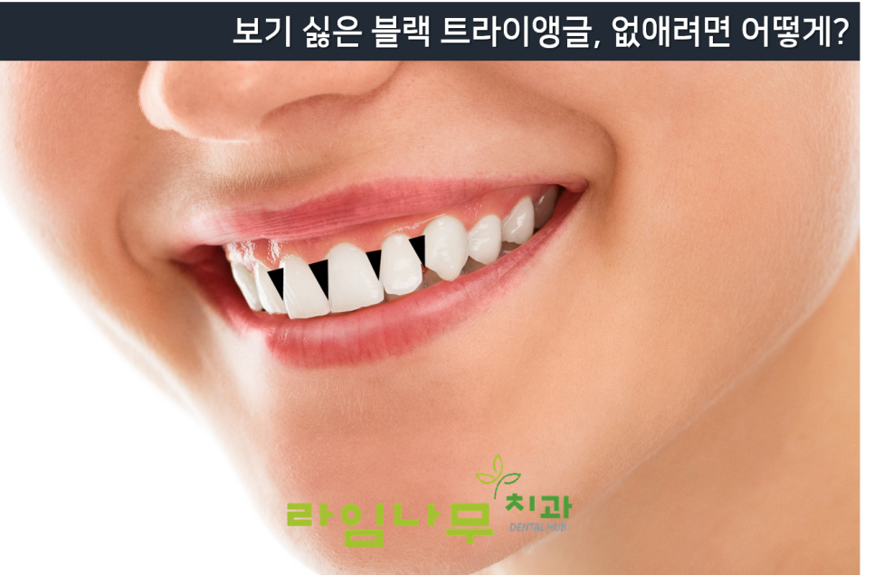 명동치과 잇몸 사이 틈? 치아 공간이 신경 쓰여요. 블랙트라이앵글/라임나무치과 관련 이미지 3