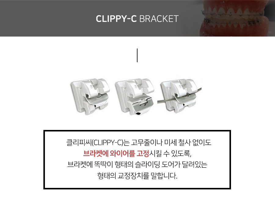 클리피씨 교정장치를 이용한 보다 빠르고 덜 아픈 교정 관련 이미지 3