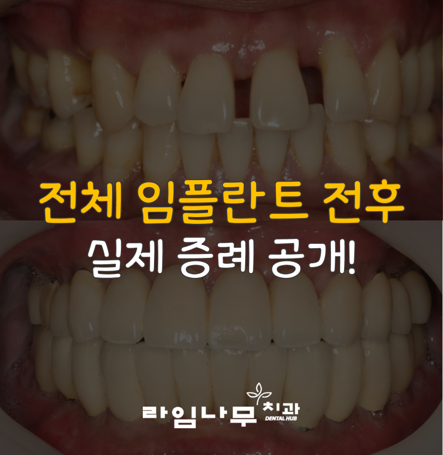 명동치과 전체임플란트 증례! 치주염으로 전체 치아의 기능을 상실한 치아 관련 이미지 1