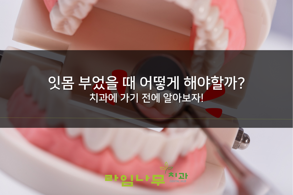 잇몸 부었을때 대처법 알아보기! 명동치과 라임나무치과 관련 이미지 1