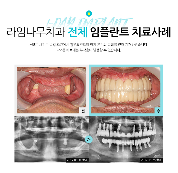 무치악임플란트 알아보고 계신다면? 라임나무치과에서 상담 받으세요! 관련 이미지 9