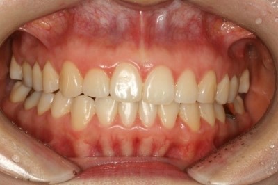 [의료진 교정일기]투명교정으로 아랫니 치열 바로잡기 관련 이미지 7