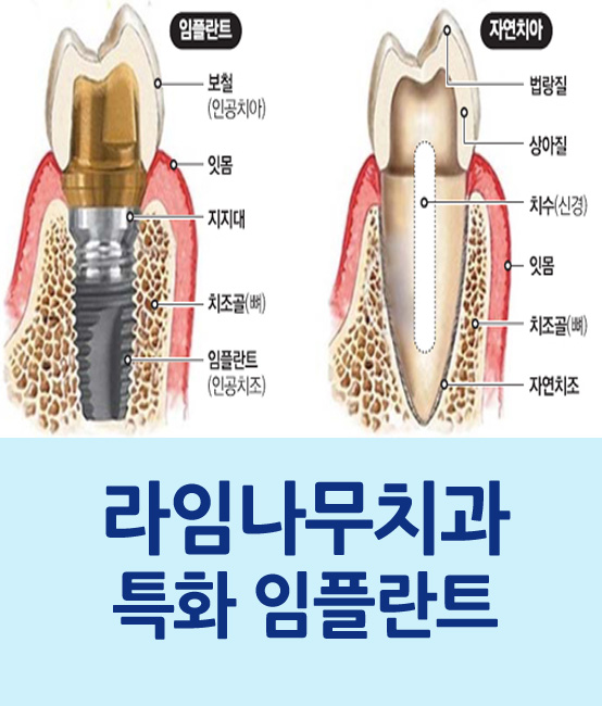 임플란트는? 라임나무치과만의 특화 임플란트 관련 이미지 1