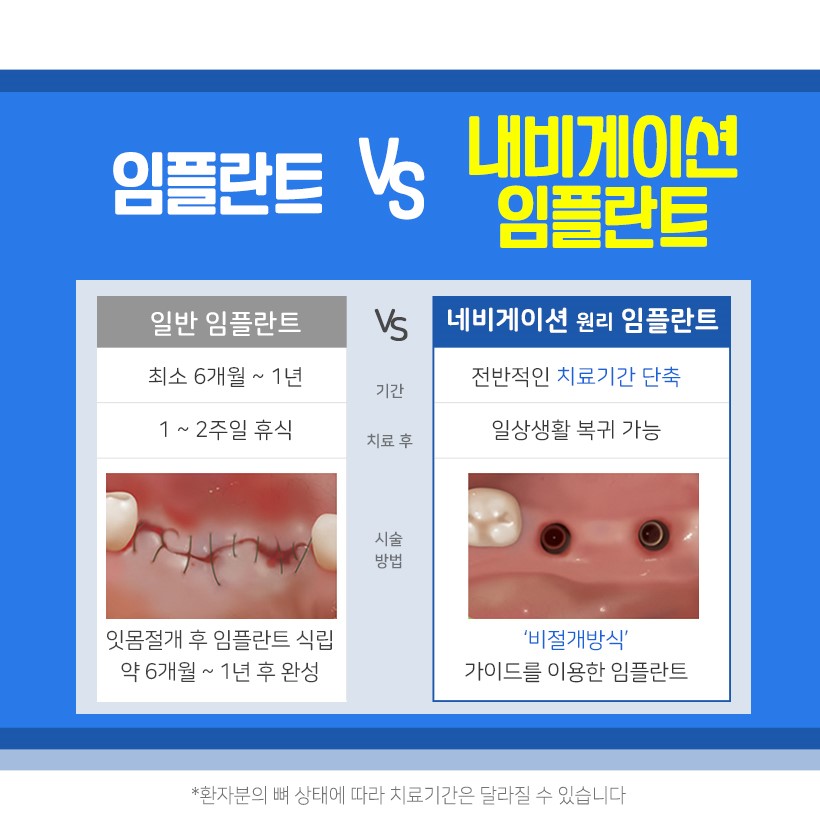 임플란트 비용 걱정 없이 내원 당일에도 가능할까? 관련 이미지 8