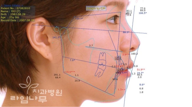 치아교정 전 진행하는 교정 진단과 검진의 차이점은? 관련 이미지 5