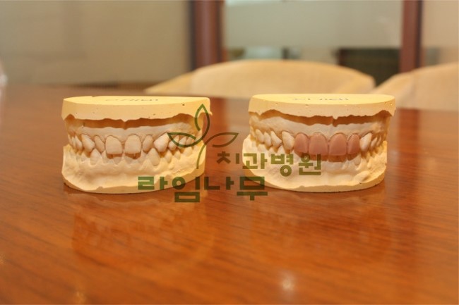 라미네이트 부작용 궁금하신가요? 관련 이미지 4