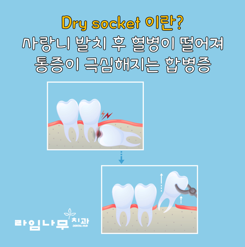 사랑니발치 후유증 드라이소켓! 명동치과 라임나무가 알려드려요 관련 이미지 2