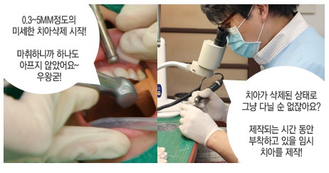 토끼이빨 , 나비치아 라미네이트 치료로 한방에 해결하자 관련 이미지 3