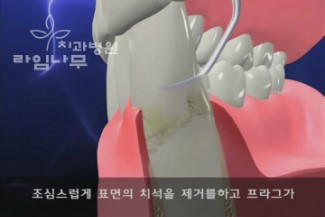 스케일링 건강보험 혜택 명동치과에서 7월부터 꼭 챙기세요 ^^ 관련 이미지 4