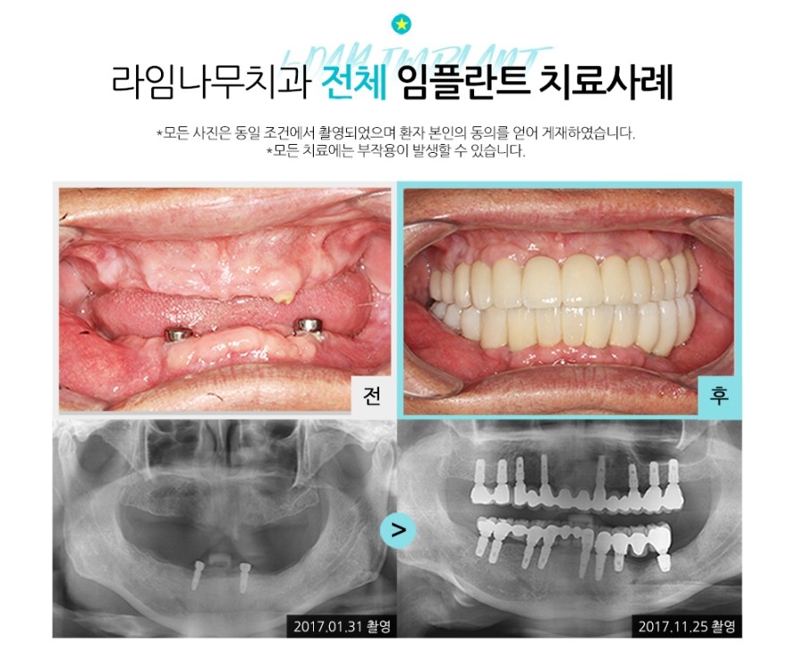 임플란트잘하는곳 라임나무치과병원입니다 관련 이미지 6