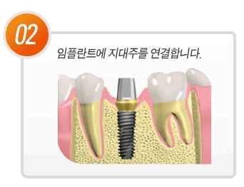 임플란트 골융합이 중요한 이유 관련 이미지 3