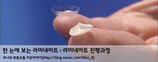 한 눈에 보는 라미네이트 : 라미네이트 치료 진행과정 관련 이미지 1