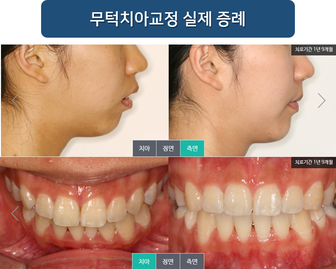 명동치과 라임나무 무턱교정 효과! 증례로 알아봐요 관련 이미지 4
