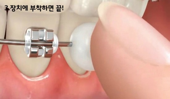 치아교정 치료 노하우 BEST3 관련 이미지 4
