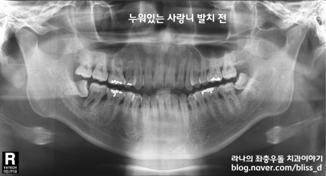 사랑니 발치 잘하는 명동치과 어디? 관련 이미지 2
