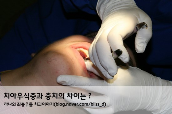 치아우식증과 충치의 차이는 ? 관련 이미지 1