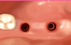 라임나무치과의 네비게이션 임플란트를 소개합니다 관련 이미지 8