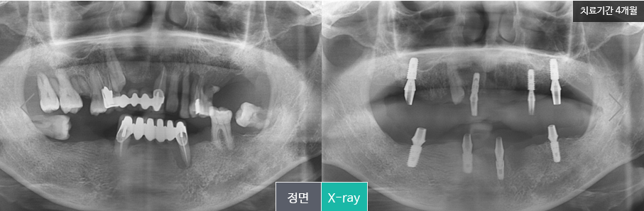 명동치과 만족도 높은 임플란트 틀니 알아보기! 라임나무 관련 이미지 6