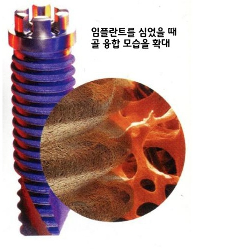 라나의 임플란트 이야기 - 임플란트 치료기간 얼마나 걸려요? 관련 이미지 4