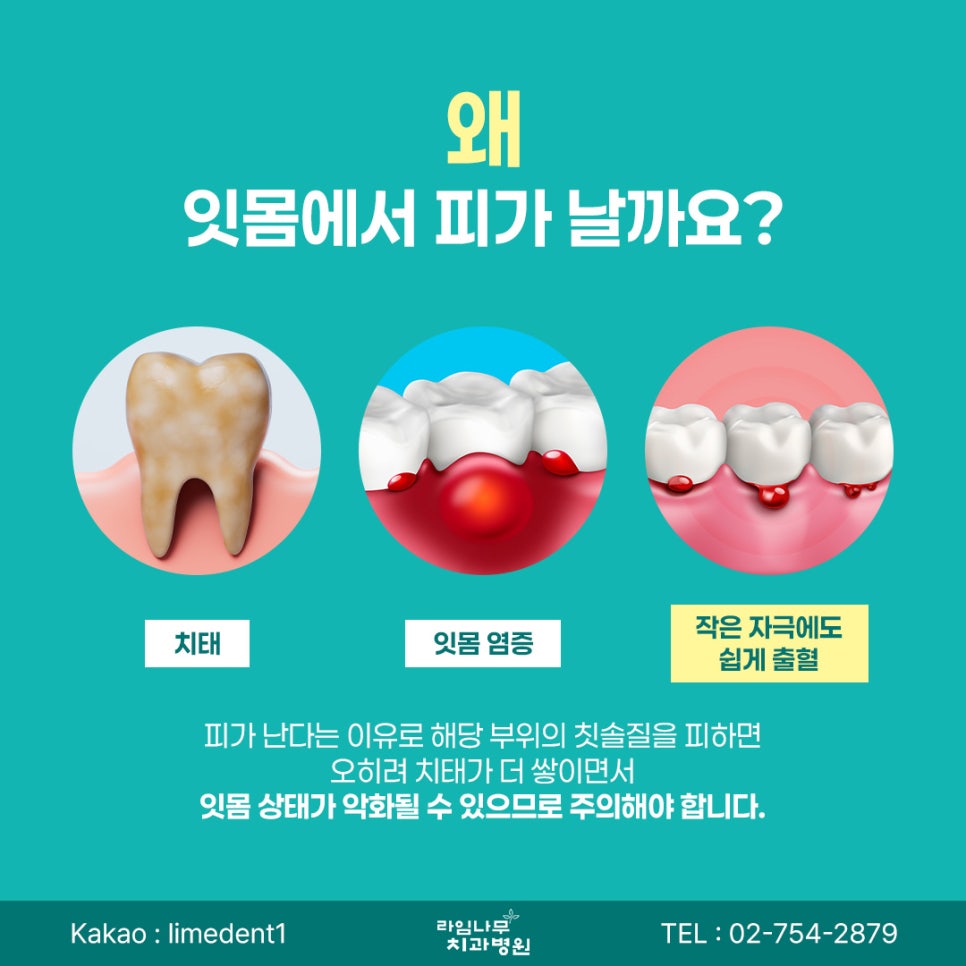 Myeongdong Dental Clinic: Bleeding When Brushing May Be a Sign of Gum Disease image 3