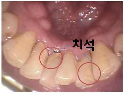 치아통증 원인 어떤게 있을까? 관련 이미지 3