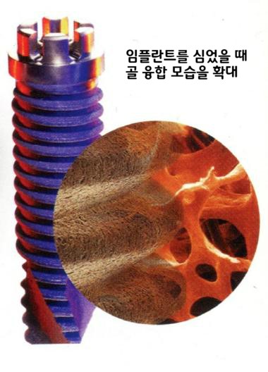 성공적인 임플란트를 위한 표면처리 기술 얼마나 알고 계신가요? 관련 이미지 5
