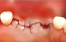라임나무치과의 네비게이션 임플란트를 소개합니다 관련 이미지 7