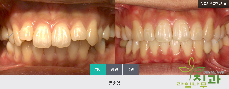 [명동 라임나무치과] 돌출입 교정, 눈에 띄지 않는 콤비교정으로 빠르게! 관련 이미지 6