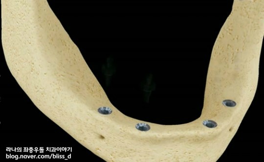 임플란트 틀니가 틀니보다 나은 이유 3가지 관련 이미지 5