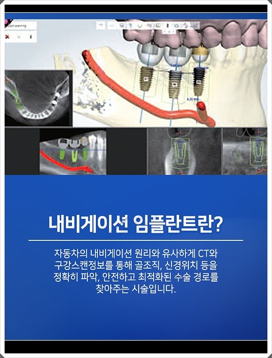 오스템임플란트비용 합리적으로 가능합니다 관련 이미지 6