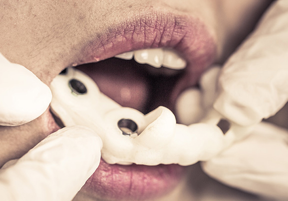 라임나무치과의 네비게이션 임플란트를 소개합니다 관련 이미지 5