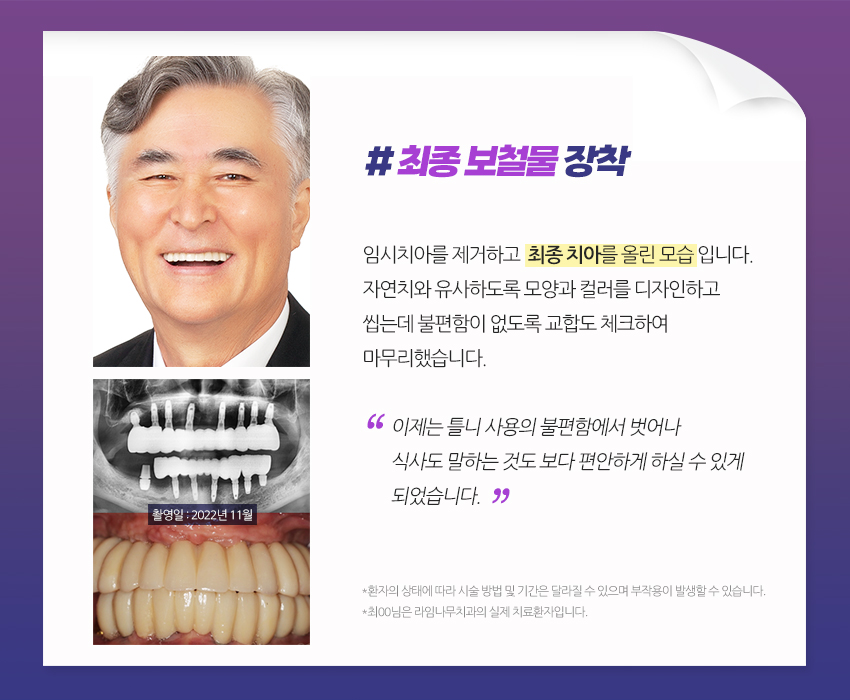 [라임나무치과]네비게이션 원리 임플란트, 실제 사례를 통해 알아봤습니다. 관련 이미지 5