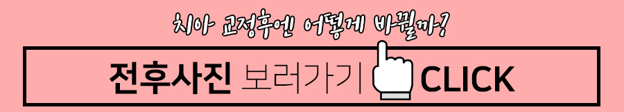 클리피씨 교정장치를 이용한 보다 빠르고 덜 아픈 교정 관련 이미지 12