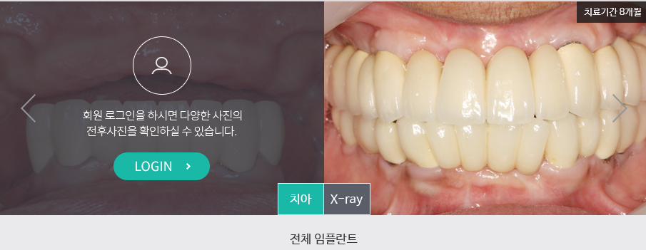 당일임플란트 어떻게 하나요? 명동 라임나무치과 관련 이미지 9