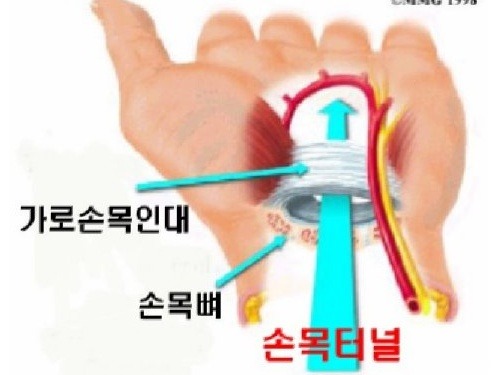 [명동치과 라임나무]손목터널증후군 초기증상, 손목 스트레칭 필수적입니다 관련 이미지 3