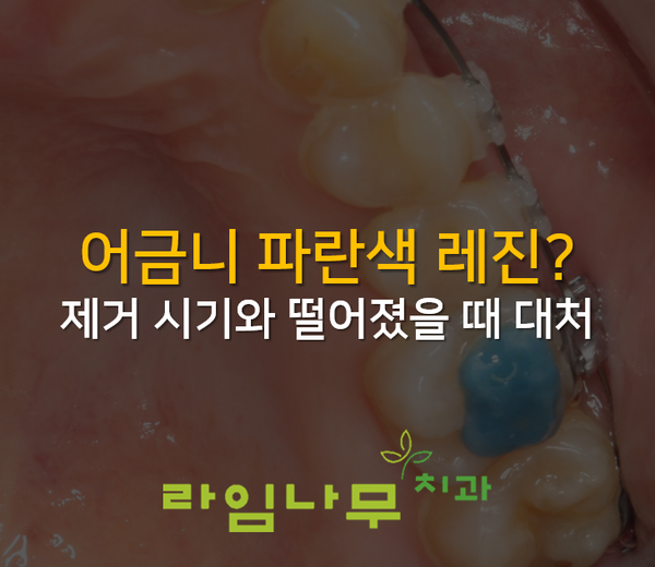 치아교정 중 어금니 파란색 레진? 제거시기 떨어졌을 때 알아봐요! 명동치과 관련 이미지 1