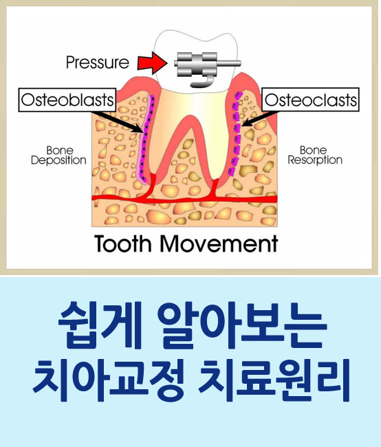 [명동치과 라임나무]치아교정, 원리가 무엇일까요 관련 이미지 1