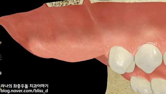임플란트 뼈이식이 필요한 이유 관련 이미지 12