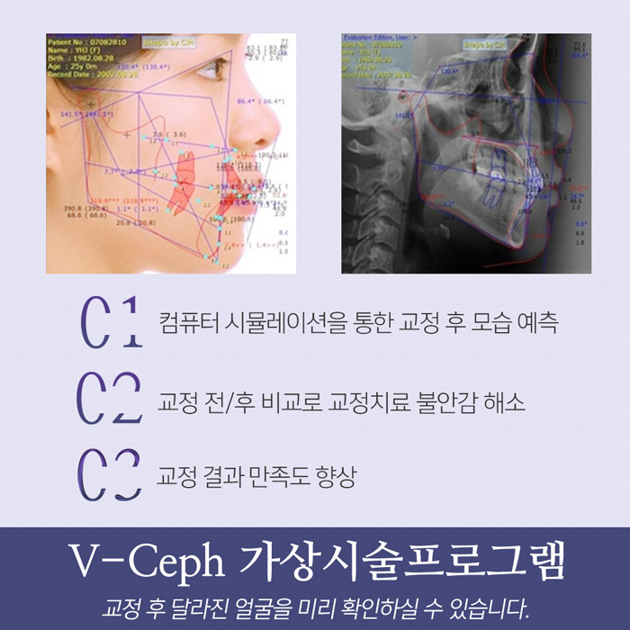 만족스러운 치아교정을 위한 사전 체크포인트 관련 이미지 5