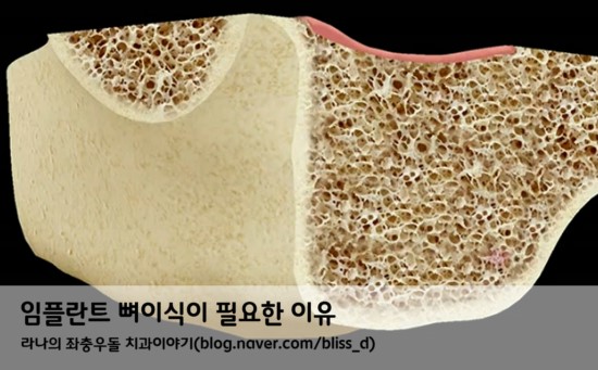 임플란트 뼈이식이 필요한 이유 관련 이미지 6