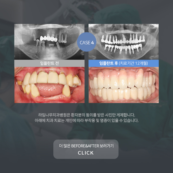 뼈이식임플란트 신중히 알아보자구요 관련 이미지 11