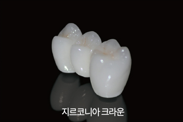 치아를 씌우는 크라운 보철치료! PFM크라운? 지르코니아? 어떤 종류가 있나요? 관련 이미지 6