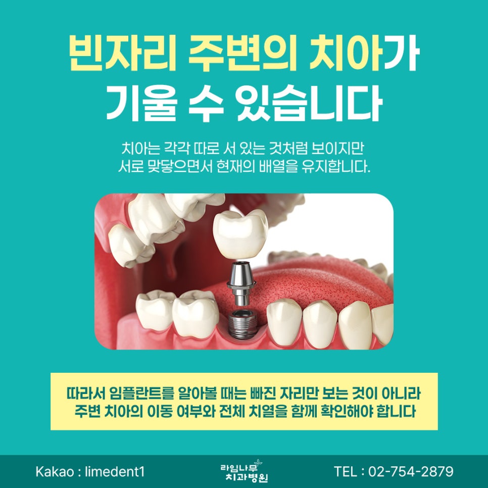 Myeongdong Dental Implants: Can Leaving a Missing Tooth Untreated for a Long Time Affect the Surrounding Teeth? image 3