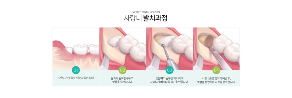 [명동치과] 사랑니 안뽑으면 어떻게 되나요? 신경과 근접한 매복사랑니 발치 가능한 라임나무치과 관련 이미지 6