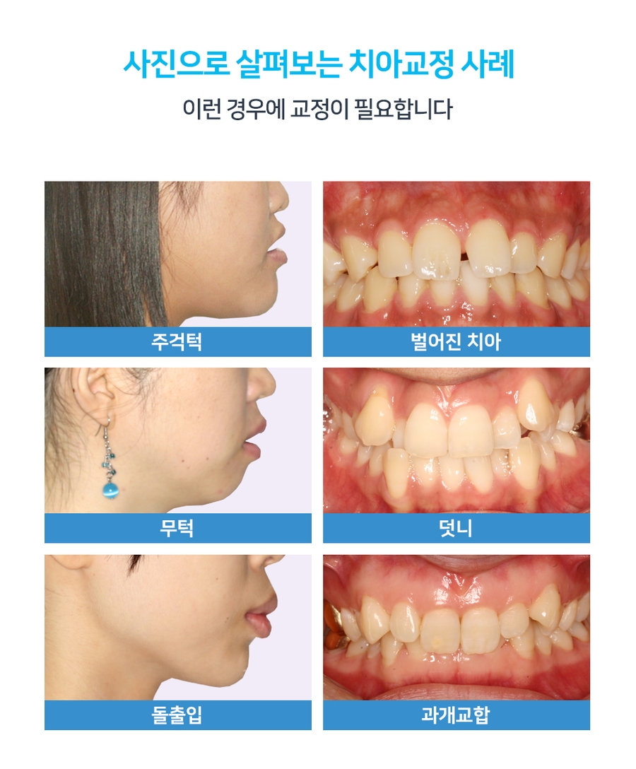 [주걱턱 무턱 돌출입] 치아교정의 선택기준 관련 이미지 3
