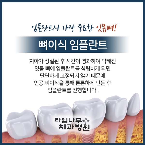 뼈이식임플란트 신중히 알아보자구요 관련 이미지 1