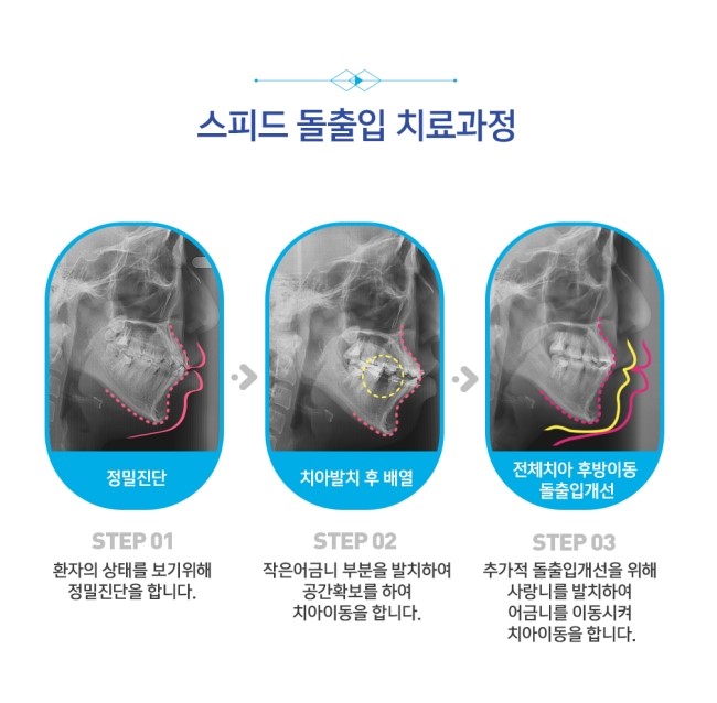 스피드 돌출입 교정 보다 빠르게 입을 쏙 넣는 방법! 관련 이미지 4